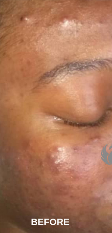 Acne Facial Procedure Before and After | Flawless Aesthetic Center