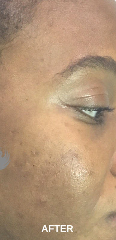 Acne Facial Procedure Before and After | Flawless Aesthetic Center