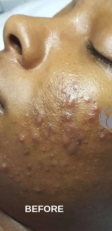 Acne Facial Procedure Before and After | Flawless Aesthetic Center