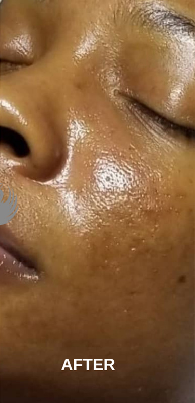 Acne Facial Procedure Before and After | Flawless Aesthetic Center