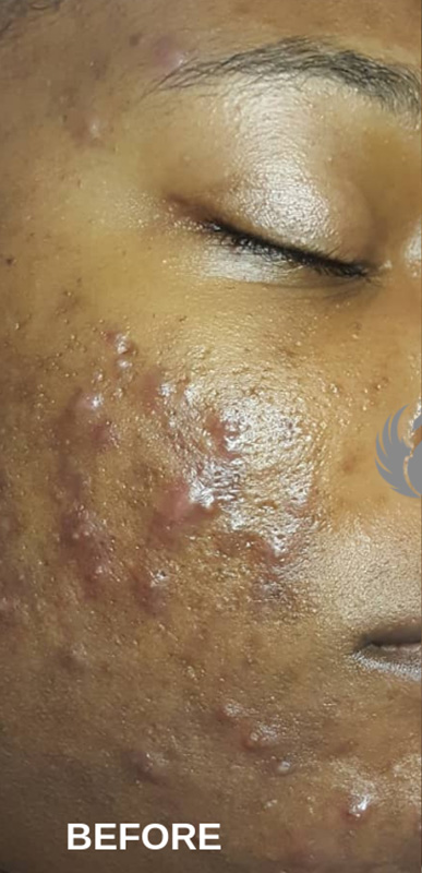 Acne Facial Procedure Before and After | Flawless Aesthetic Center