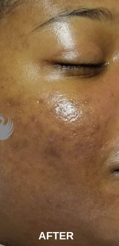 Acne Facial Procedure Before and After | Flawless Aesthetic Center