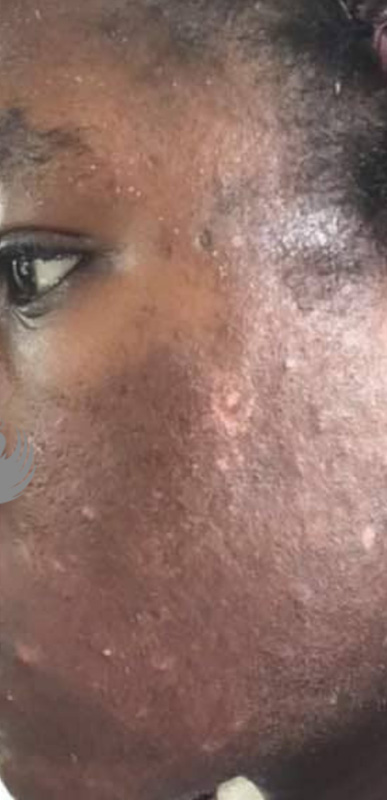 Acne Facial Procedure Before and After | Flawless Aesthetic Center