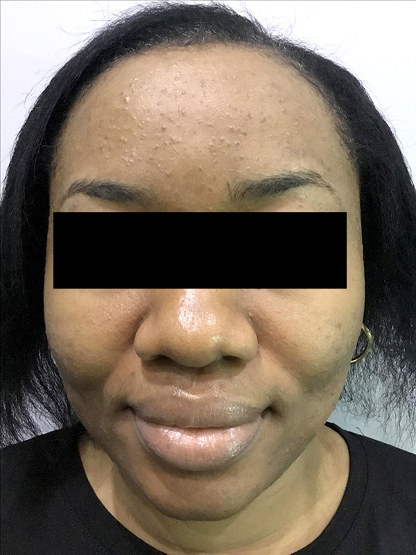 Acne Facial Procedure Before and After | Flawless Aesthetic Center