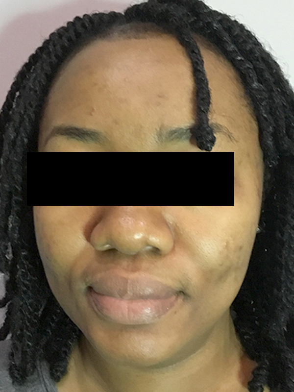 Acne Facial Procedure Before and After | Flawless Aesthetic Center