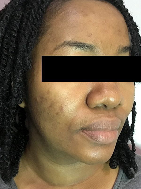 Acne Facial Procedure Before and After | Flawless Aesthetic Center