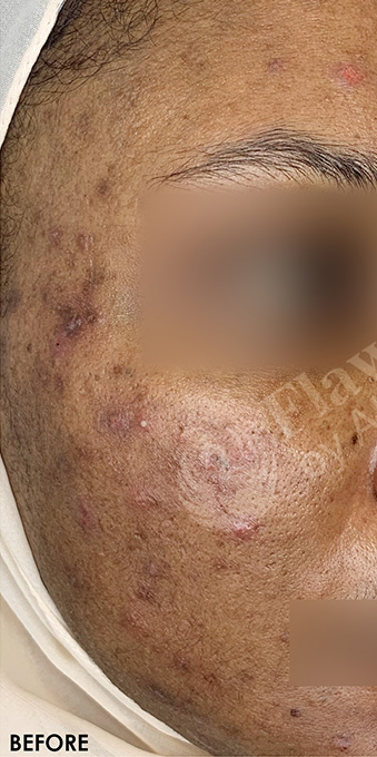 Acne Facial Procedure Before and After | Flawless Aesthetic Center