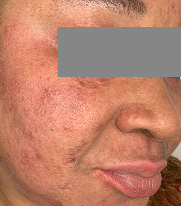 Chemical Peels Before and After | Flawless Aesthetic Center