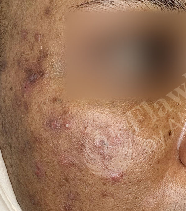 Chemical Peels Before and After | Flawless Aesthetic Center