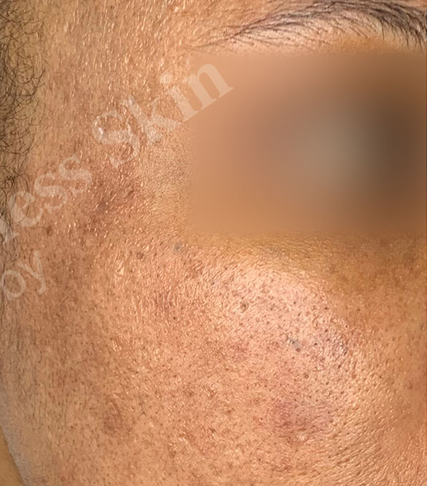 Chemical Peels Before and After | Flawless Aesthetic Center