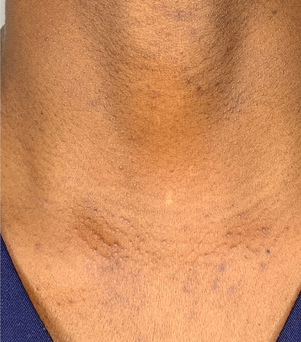 Chemical Peels Before and After | Flawless Aesthetic Center