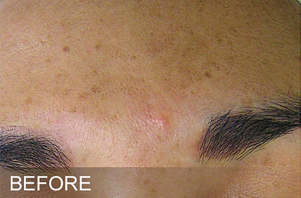 Hydrafacial Before and After | Flawless Skin