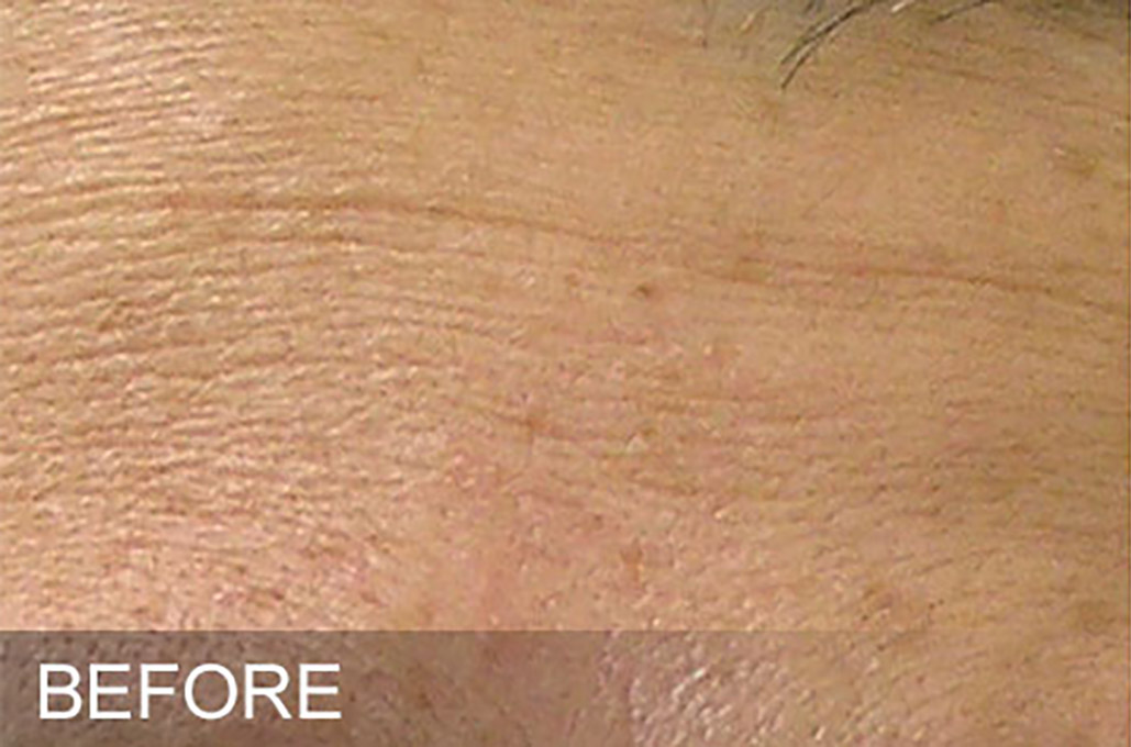 Hydrafacial Before and After | Flawless Skin