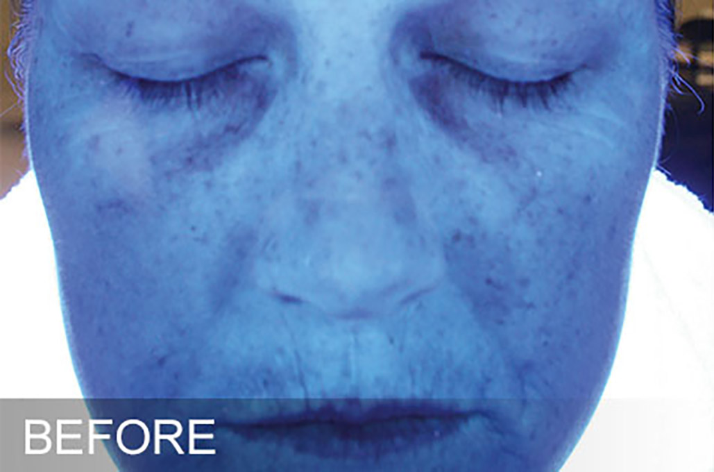 Hydrafacial Before and After | Flawless Aesthetic Center