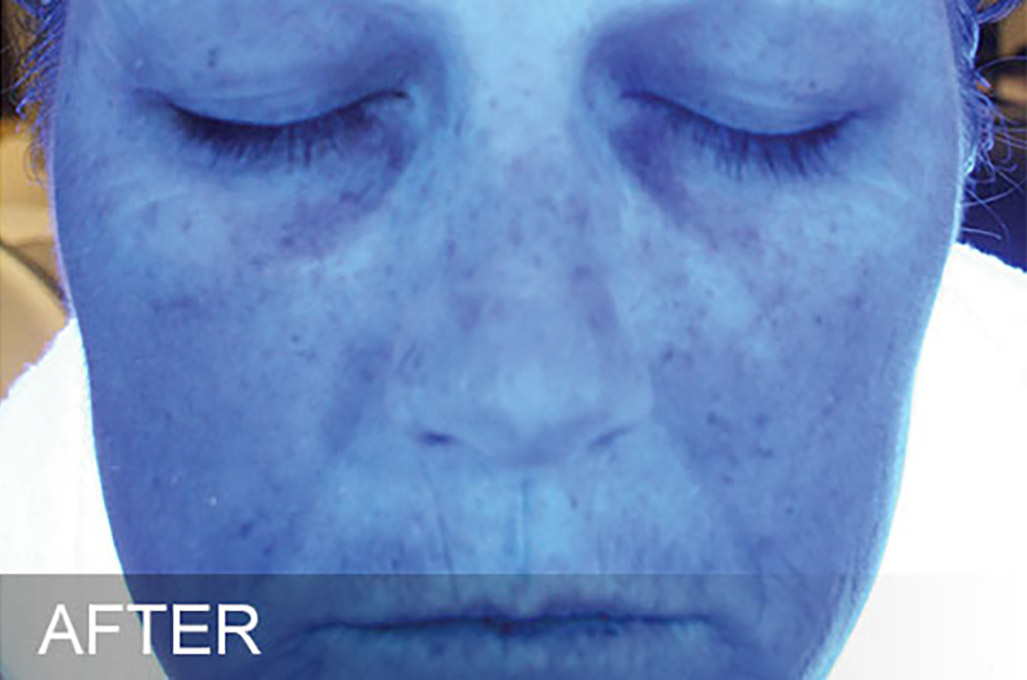 Hydrafacial Before and After | Flawless Aesthetic Center