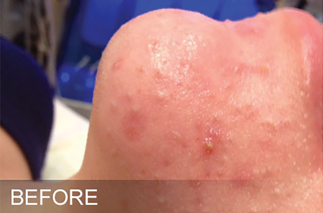 Hydrafacial Before and After | Flawless Aesthetic Center