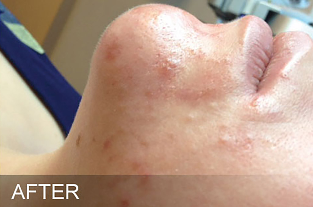 Hydrafacial Before and After | Flawless Aesthetic Center