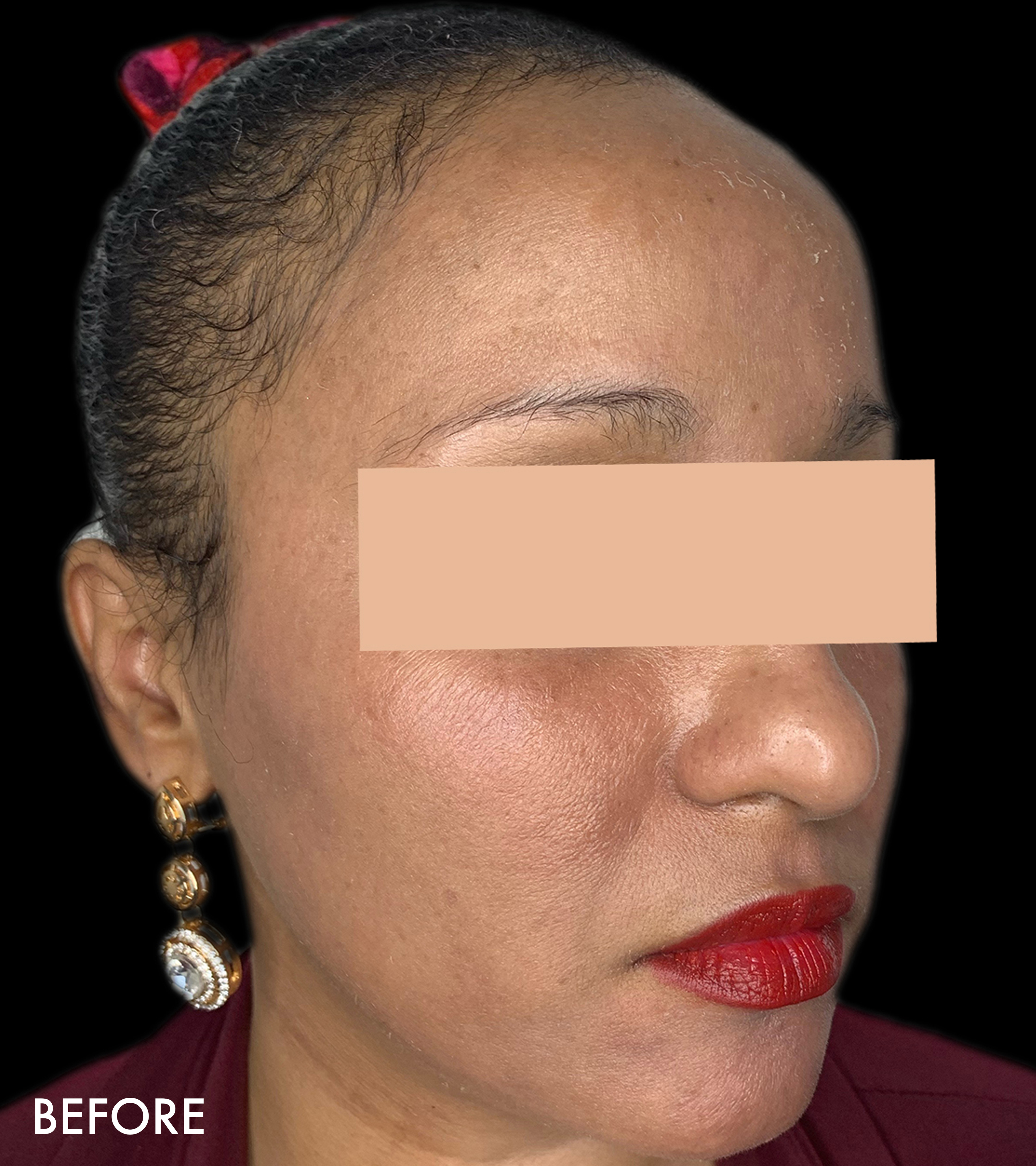 Hydrafacial Before and After | Flawless Aesthetic Center