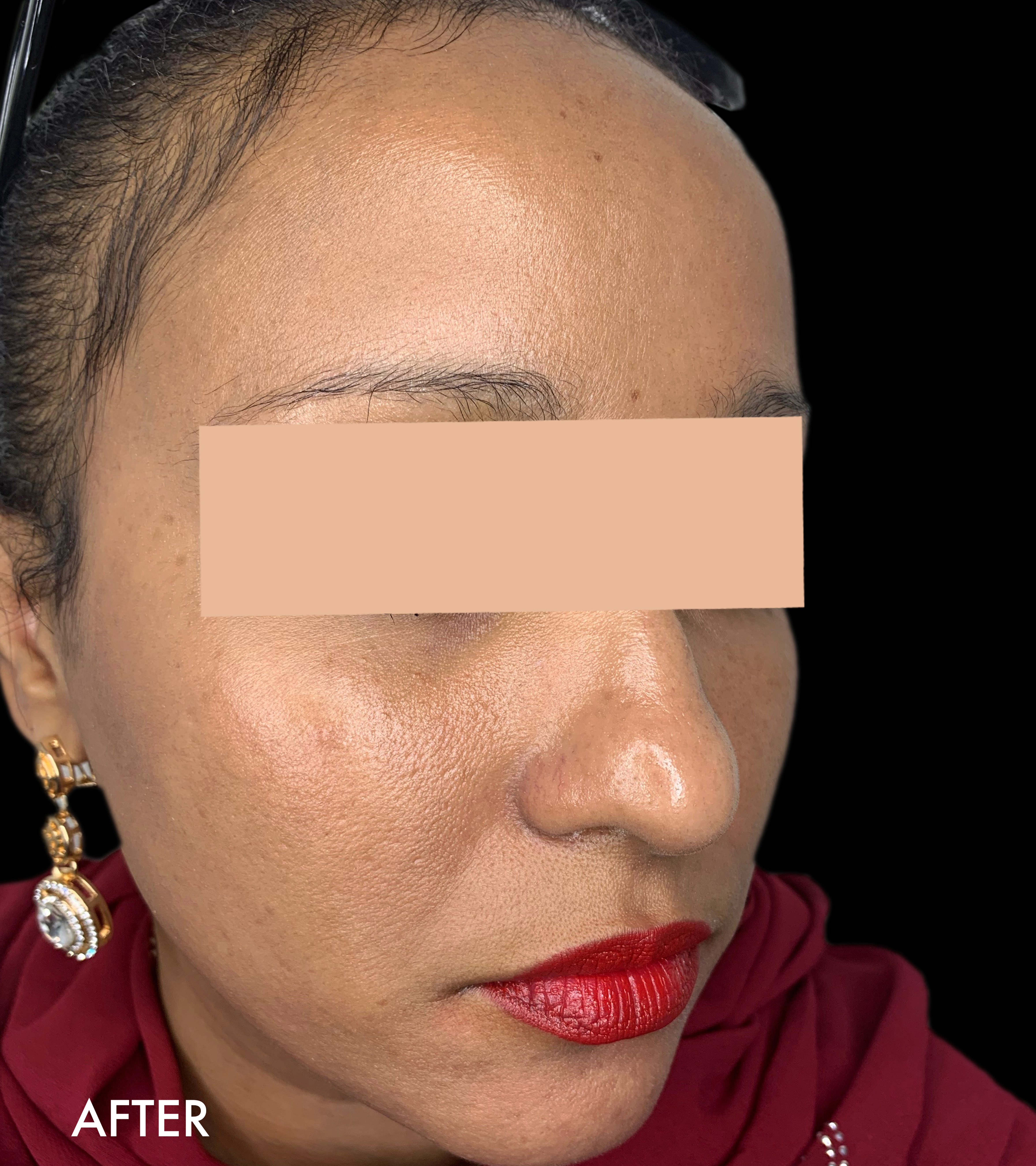 Hydrafacial Before and After | Flawless Aesthetic Center