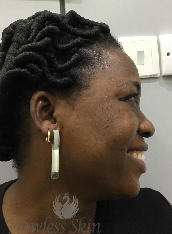 Hyperpigmentation Before and After | Flawless Aesthetic Center
