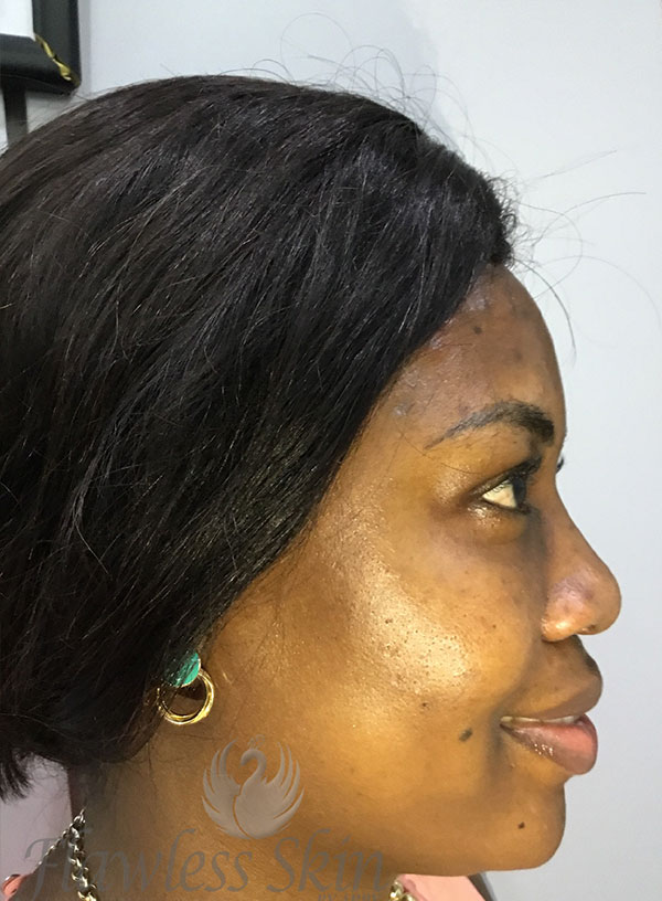 Hyperpigmentation Before and After | Flawless Aesthetic Center