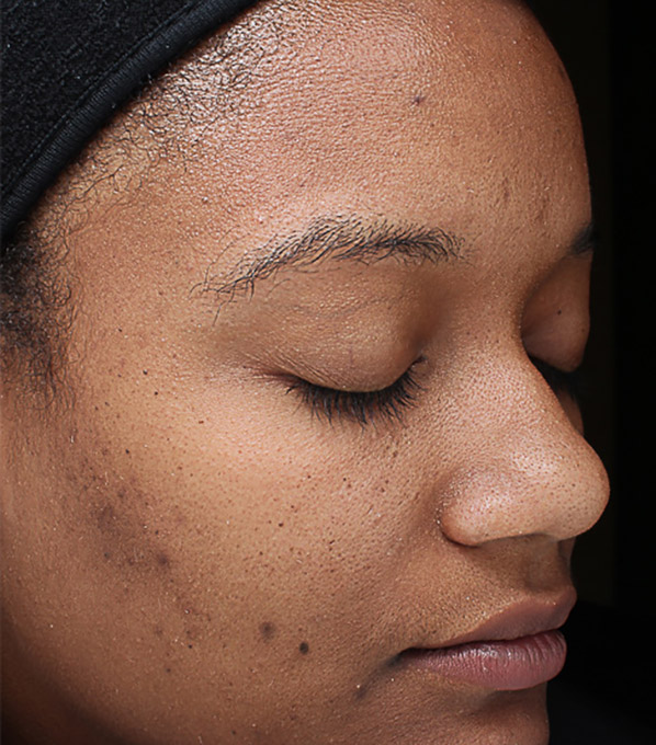 Hyperpigmentation Before and After | Flawless Aesthetic Center