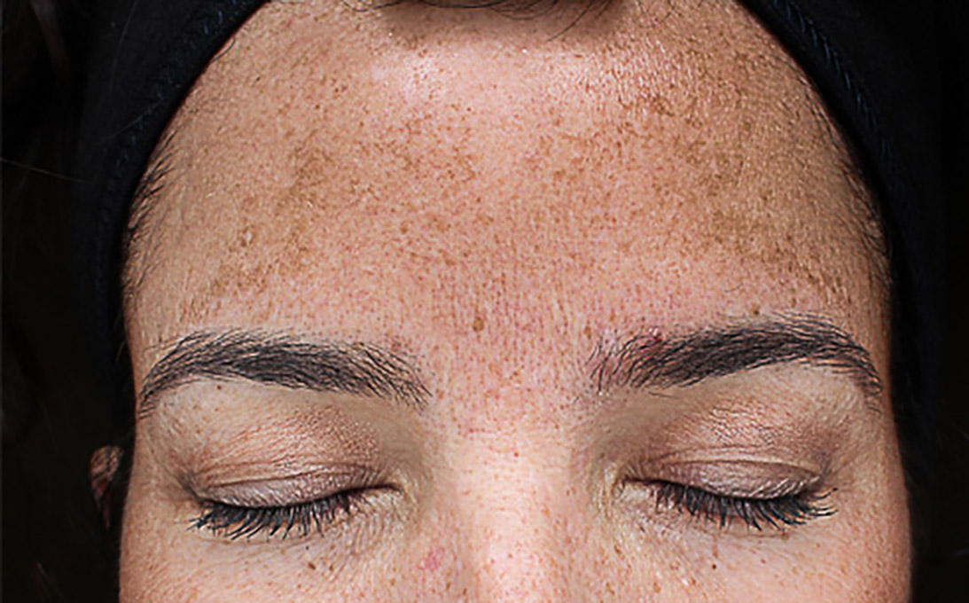 Hyperpigmentation Before and After | Flawless Aesthetic Center