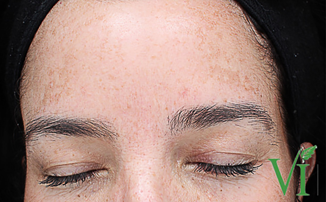 Hyperpigmentation Before and After | Flawless Aesthetic Center
