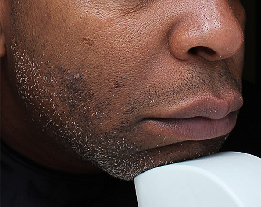 Hyperpigmentation Before and After | Flawless Aesthetic Center