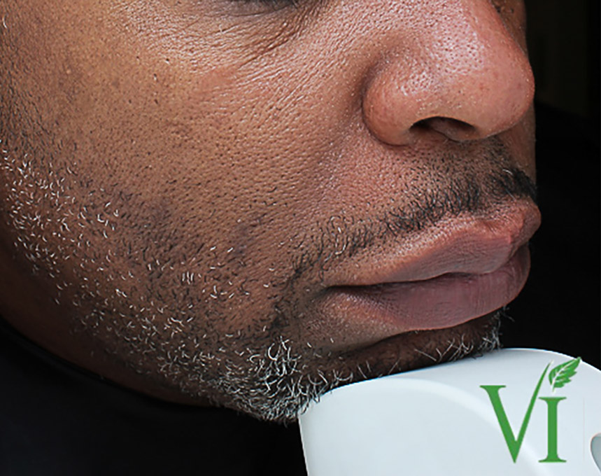 Hyperpigmentation Before and After | Flawless Aesthetic Center
