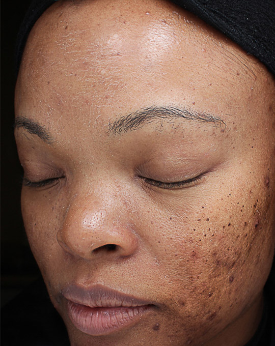 Hyperpigmentation Before and After | Flawless Aesthetic Center