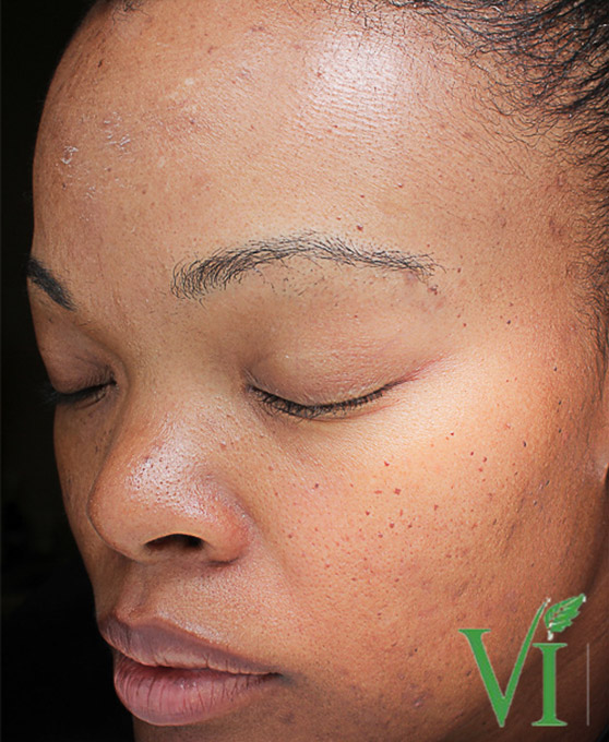 Hyperpigmentation Before and After | Flawless Aesthetic Center