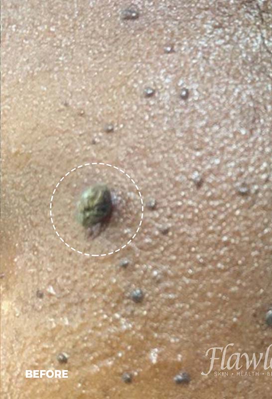Skin Tag Removal Before and After | Flawless Aesthetic Center