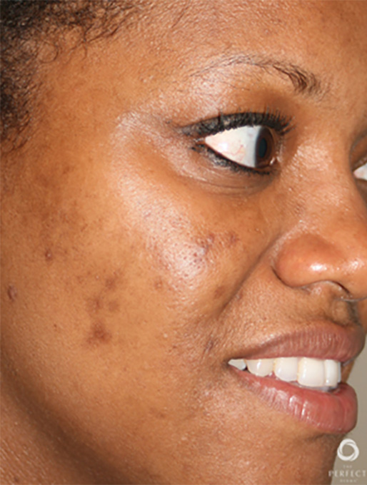 Specialty Peels Before and After | Flawless Aesthetic Center
