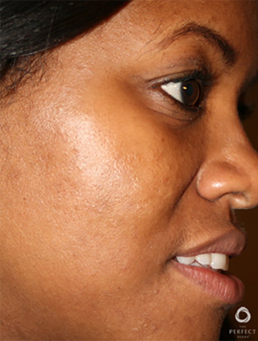 Specialty Peels Before and After | Flawless Aesthetic Center
