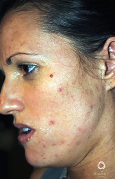 Specialty Peels Before and After | Flawless Aesthetic Center