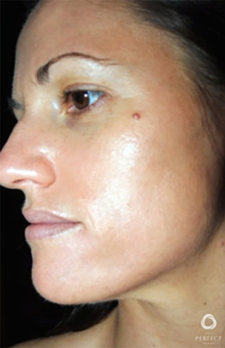 Specialty Peels Before and After | Flawless Aesthetic Center