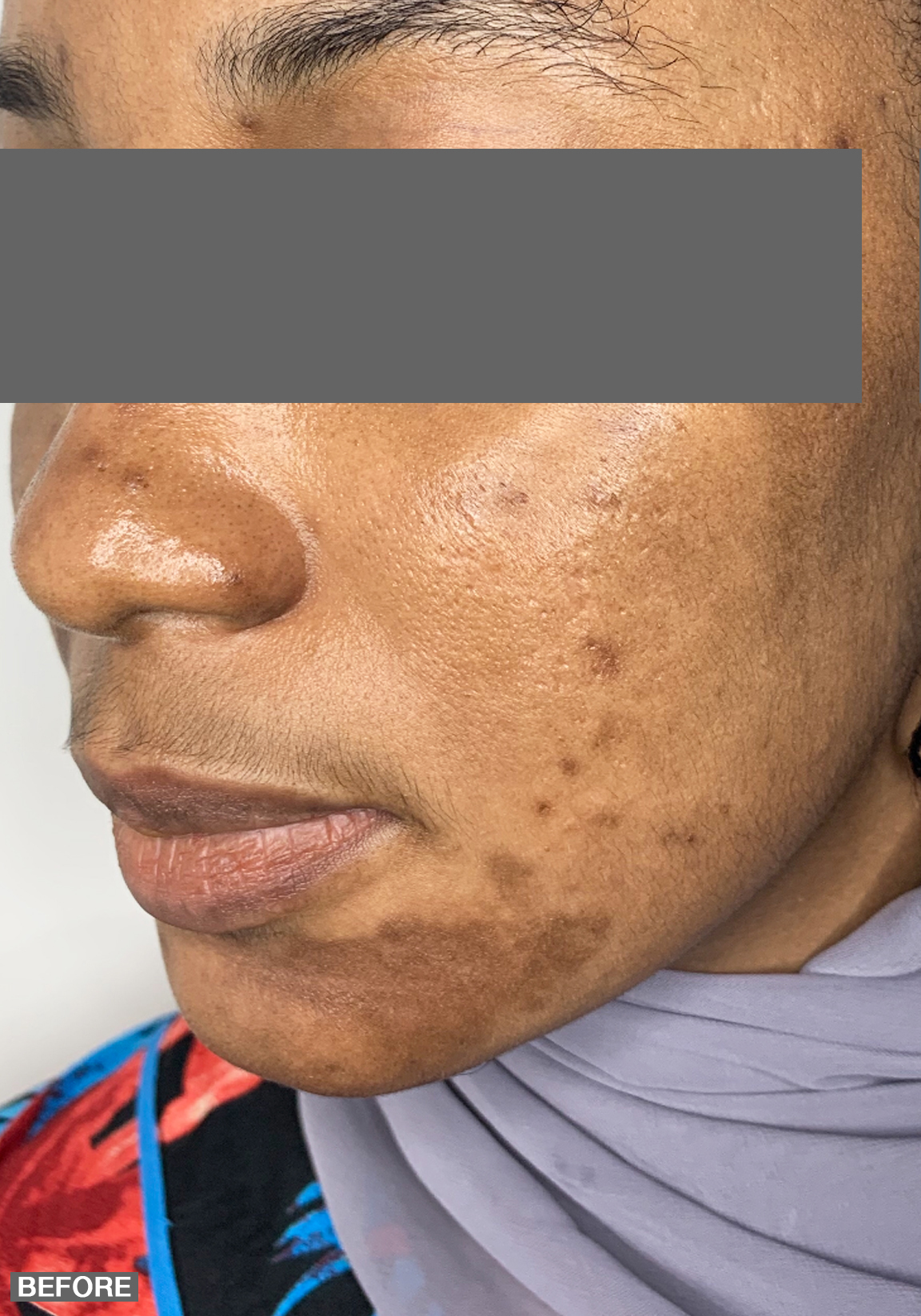 Specialty Peels Before and After | Flawless Aesthetic Center