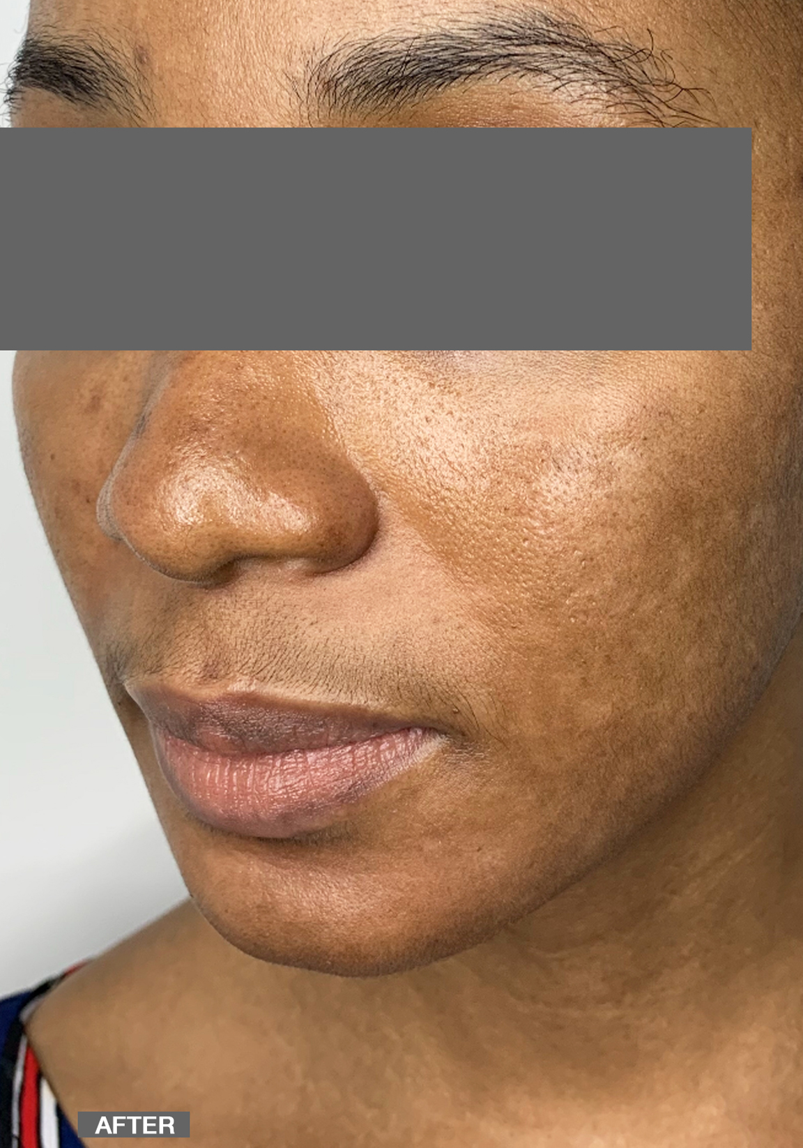 Specialty Peels Before and After | Flawless Aesthetic Center