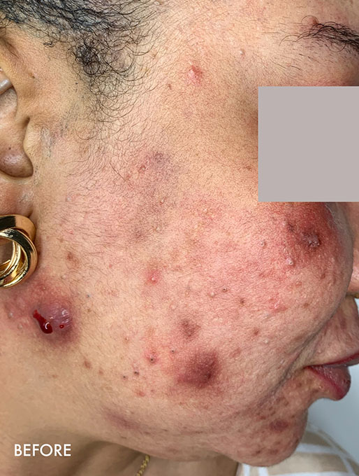 Vi Peels Before and After | Flawless Aesthetic Center