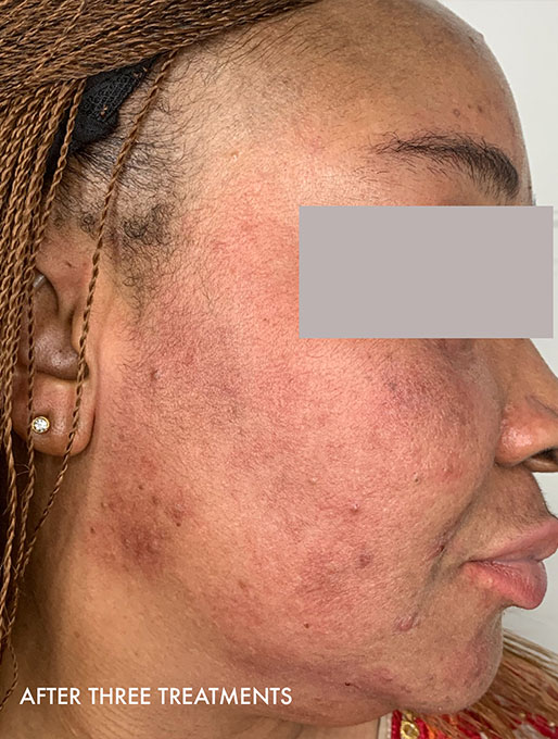 Vi Peels Before and After | Flawless Aesthetic Center