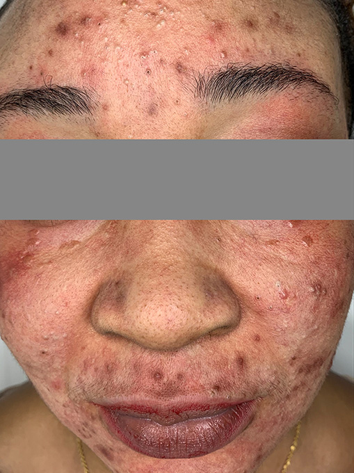 Microneedling With Prp Before and After | Flawless Aesthetic Center