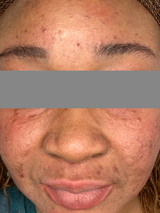 Microneedling With Prp Before and After | Flawless Aesthetic Center