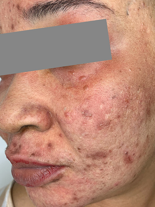 Microneedling With Prp Before and After | Flawless Aesthetic Center