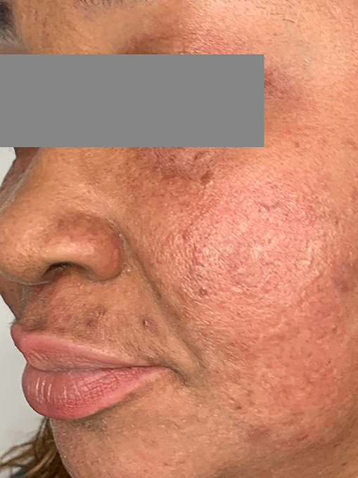 Microneedling With Prp Before and After | Flawless Aesthetic Center