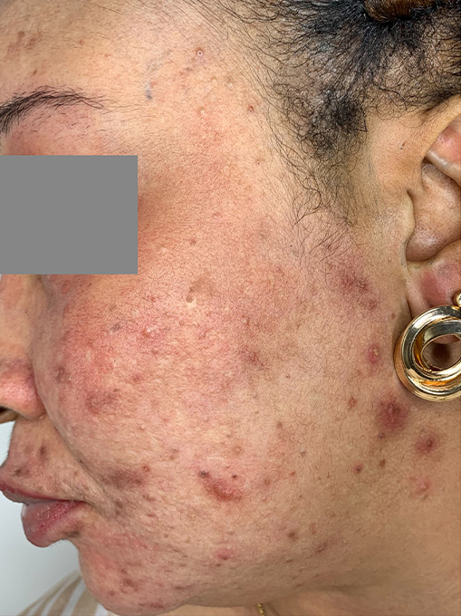 Microneedling With Prp Before and After | Flawless Aesthetic Center