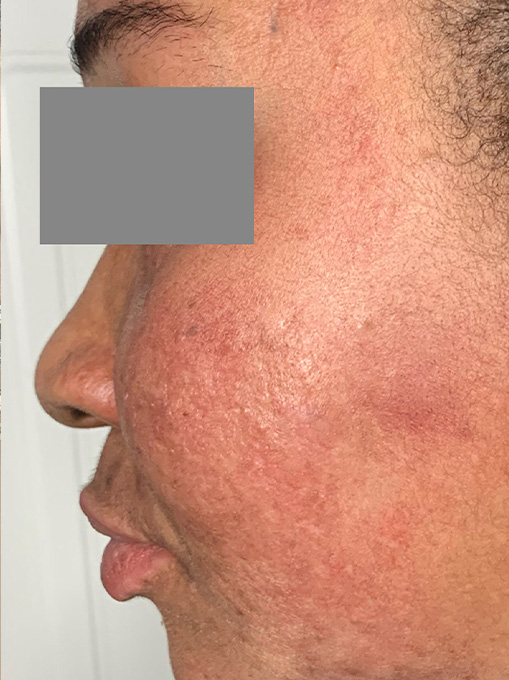 Microneedling With Prp Before and After | Flawless Skin