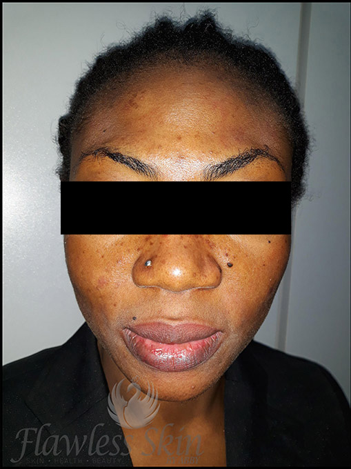 Microneedling With Prp Before and After | Flawless Aesthetic Center