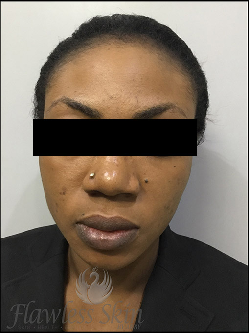 Microneedling With Prp Before and After | Flawless Aesthetic Center