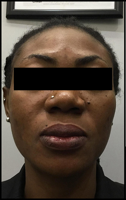 Microneedling With Prp Before and After | Flawless Aesthetic Center